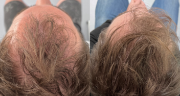 SEFFIHAIR stamcel behandeling voor haargroei